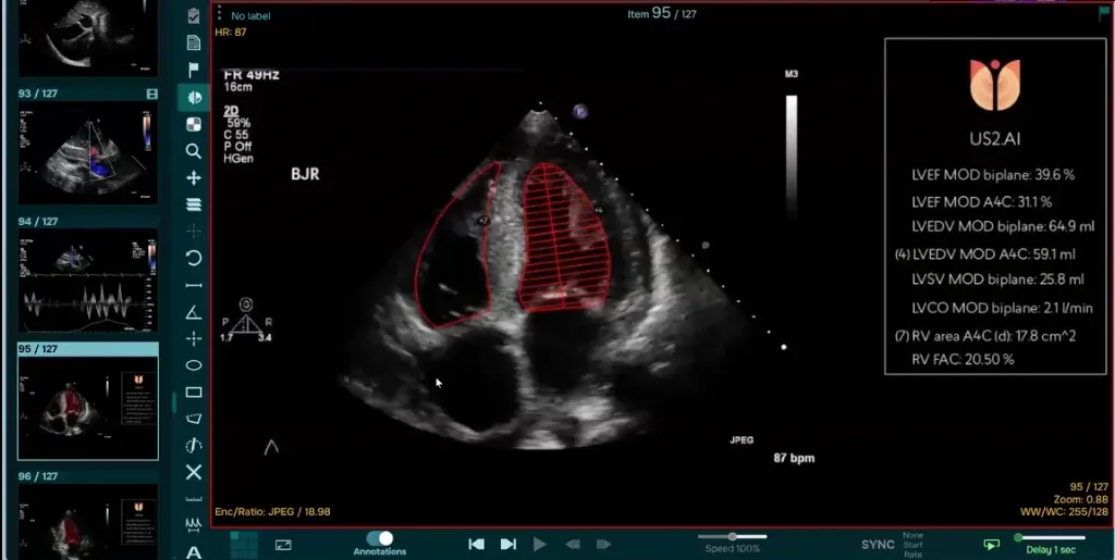 The Studycast viewer showing an apical four-chamber echo image with Us2.ai contours drawn on the heart and a Us2.ai panel listing ejection fraction, volume and right ventricular measurements.