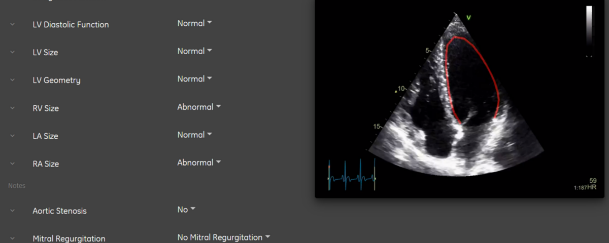 AI For Echocardiography