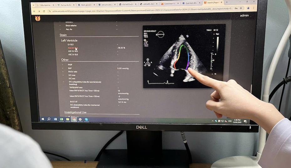 AI Echo in Vietnam: Revolutionizing Cardiac Cardiac Care and Heart Failure Diagnosis
