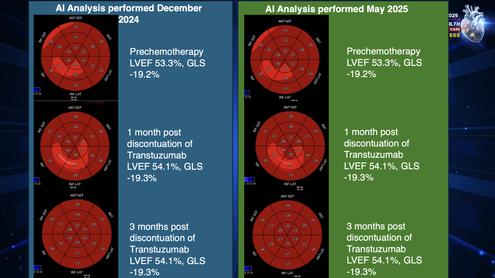 AI Echo Eliminating Intraobserver Variability